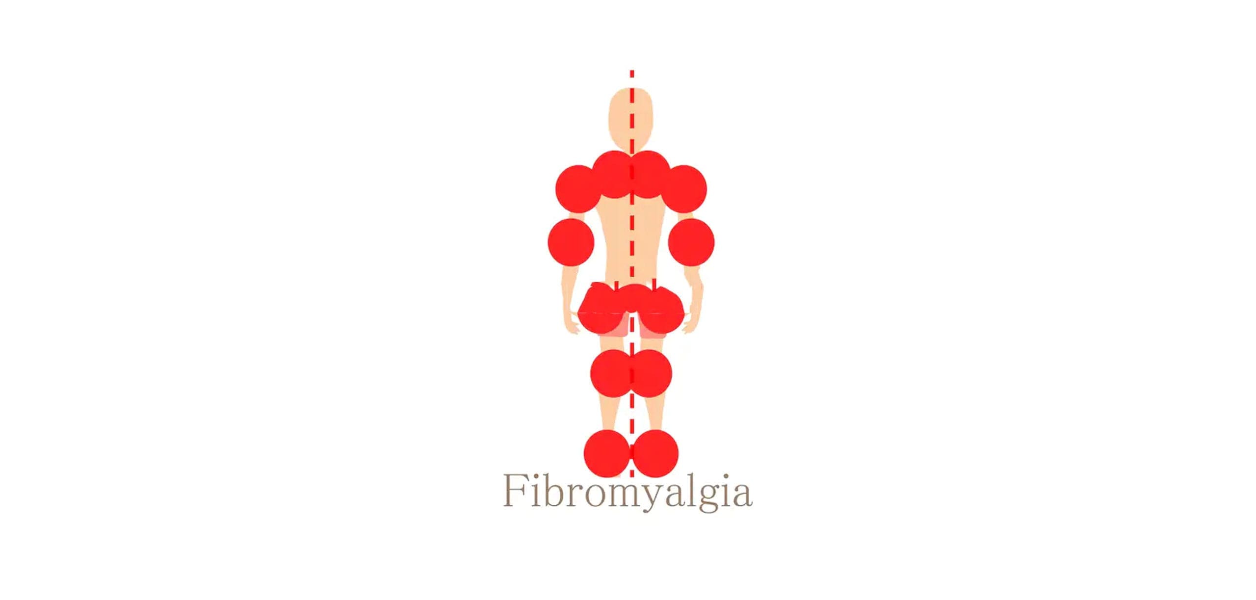 fibromyalgia chiropractor