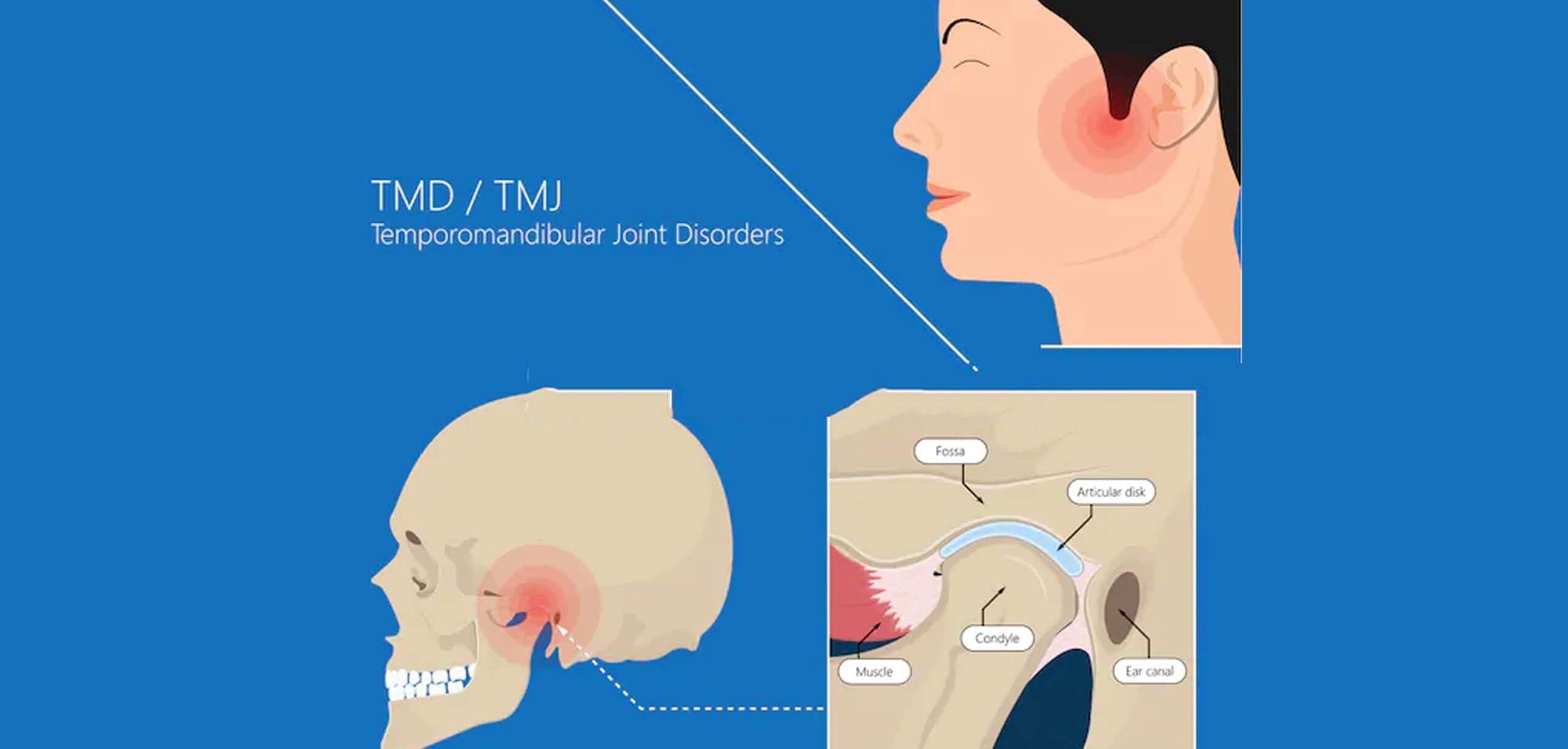 tmj temporomandibular joint disorder near Gaithersburg MD